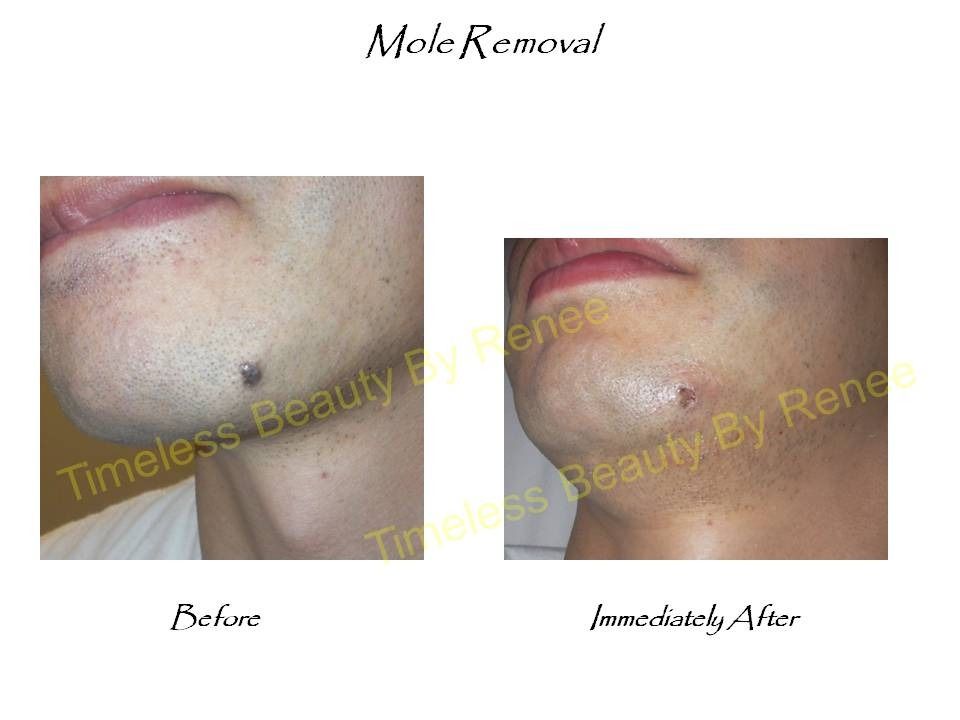 A picture of a man 's face before and after mole removal