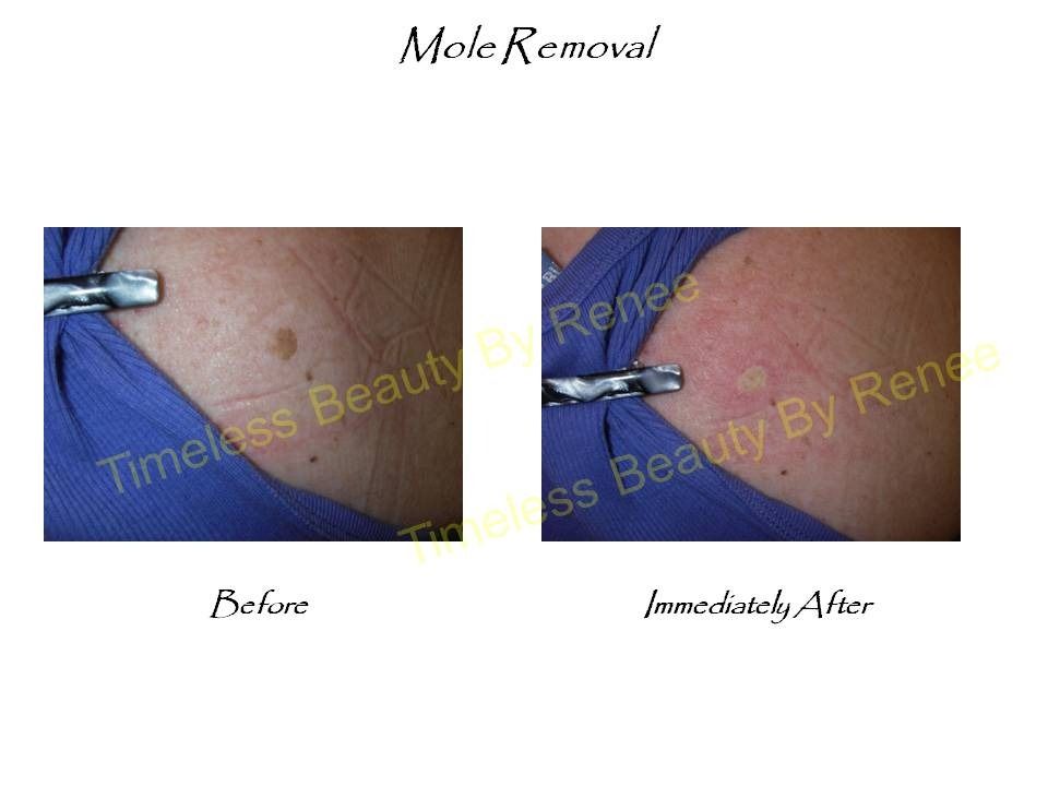 A before and after picture of a mole removal