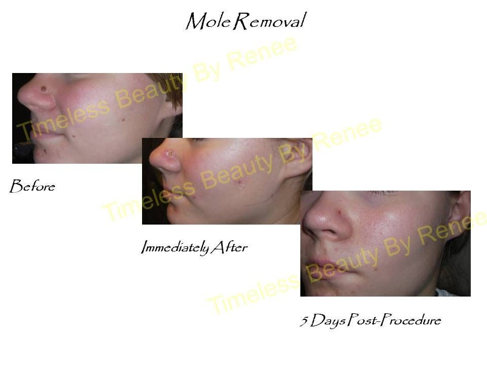 A picture of a woman 's face before and after mole removal