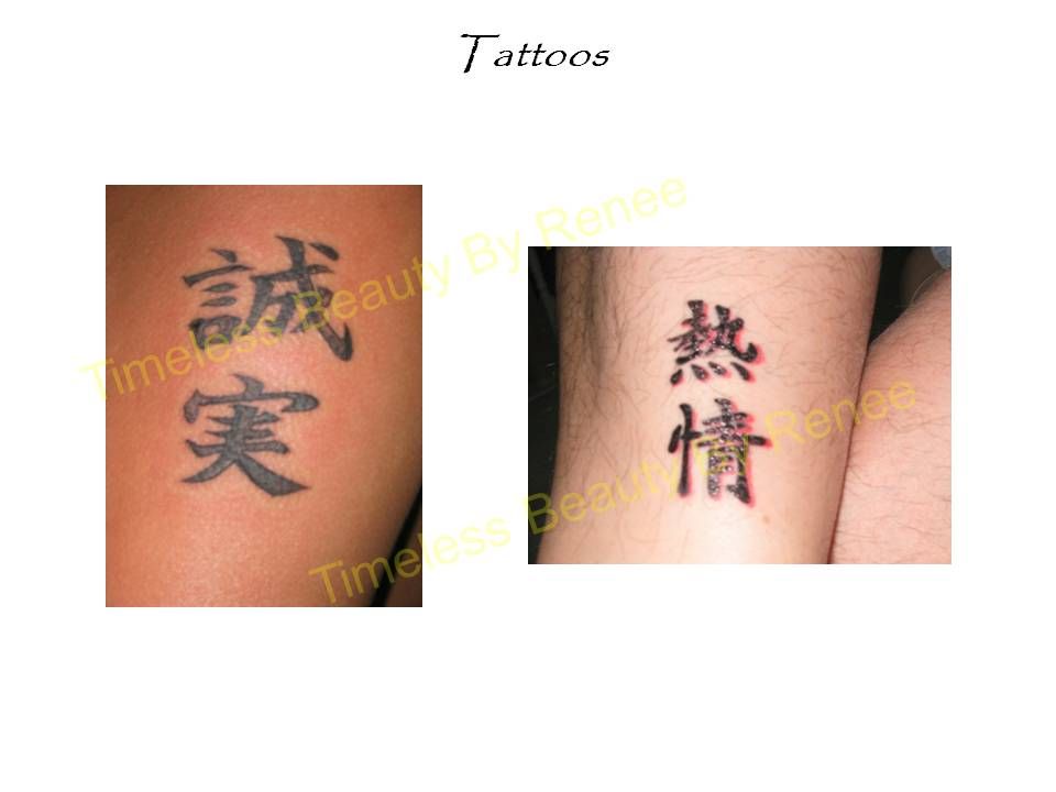 A before and after picture of a tattoo removal