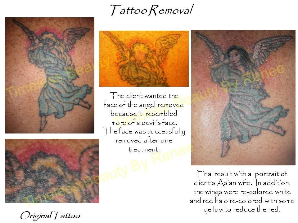 A picture of a tattoo with the words tattoo removal on it