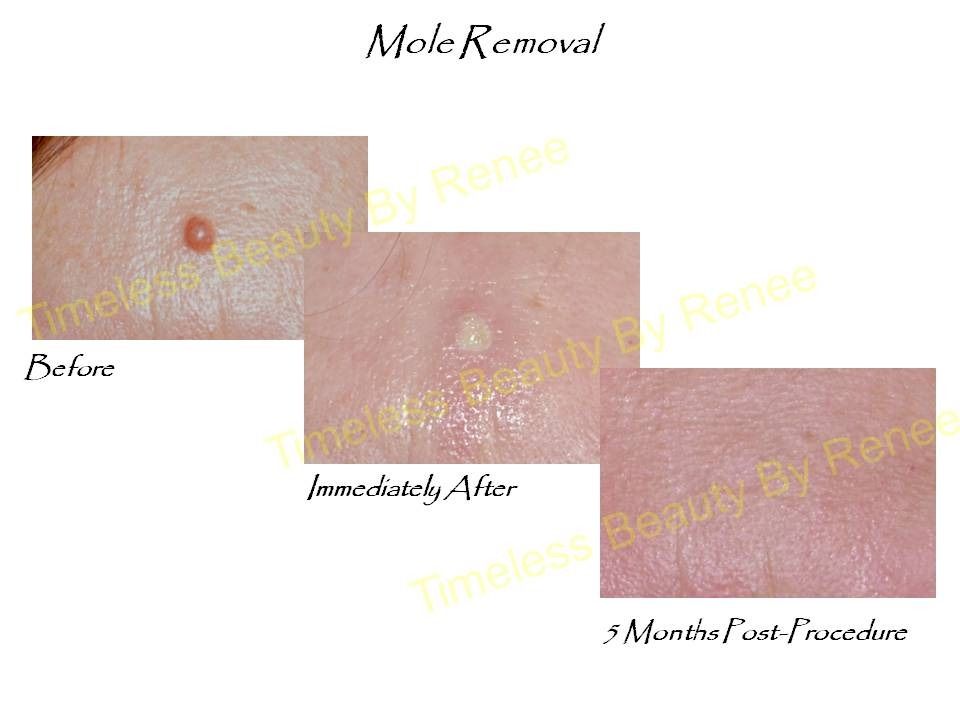 A before and after picture of a mole removal procedure