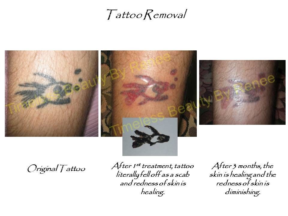 A picture of a tattoo before and after removal