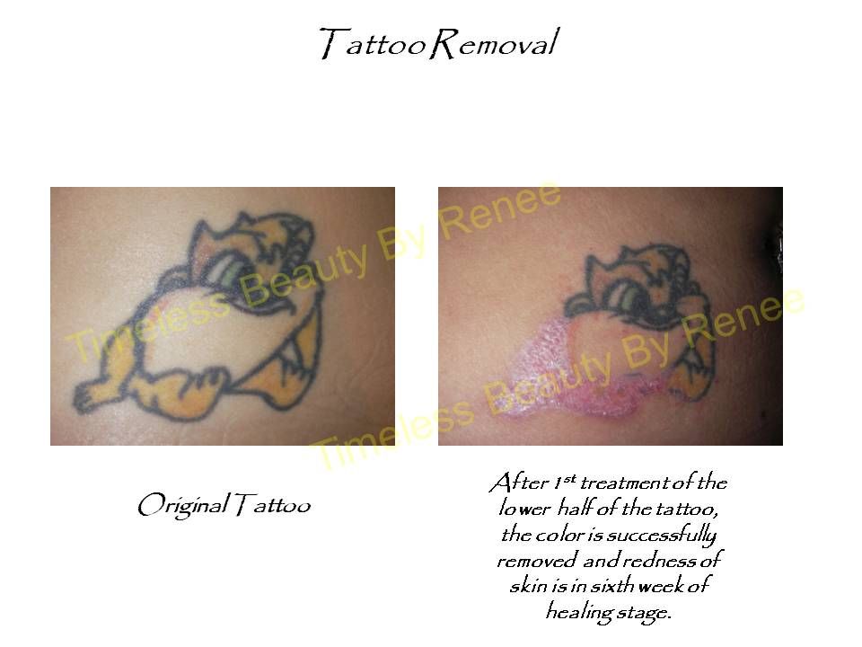 A before and after picture of a tattoo removal