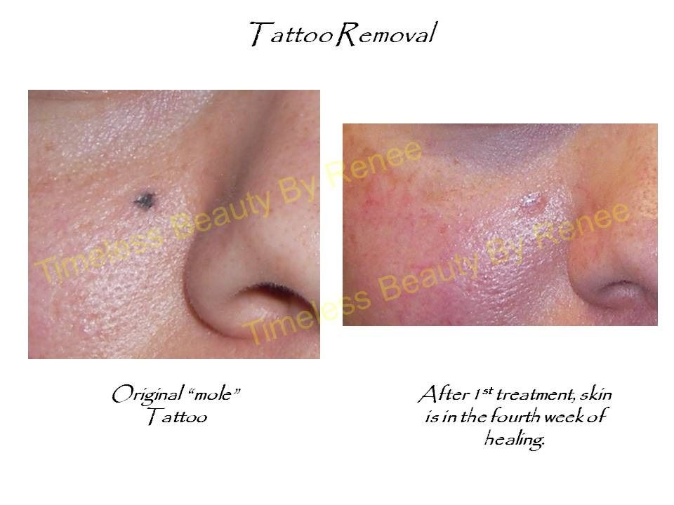 A before and after picture of a tattoo removal procedure