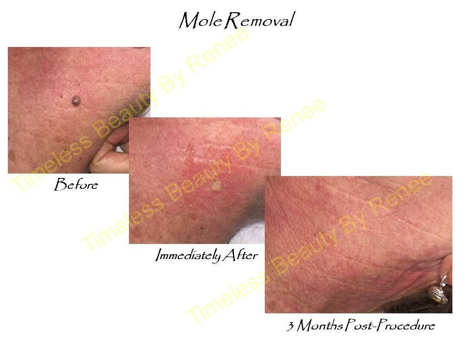 A before and after picture of a mole removal procedure