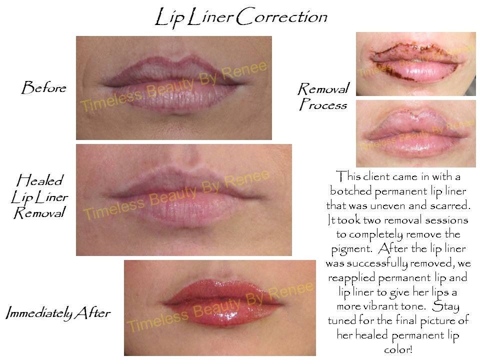 A before and after picture of lip liner correction