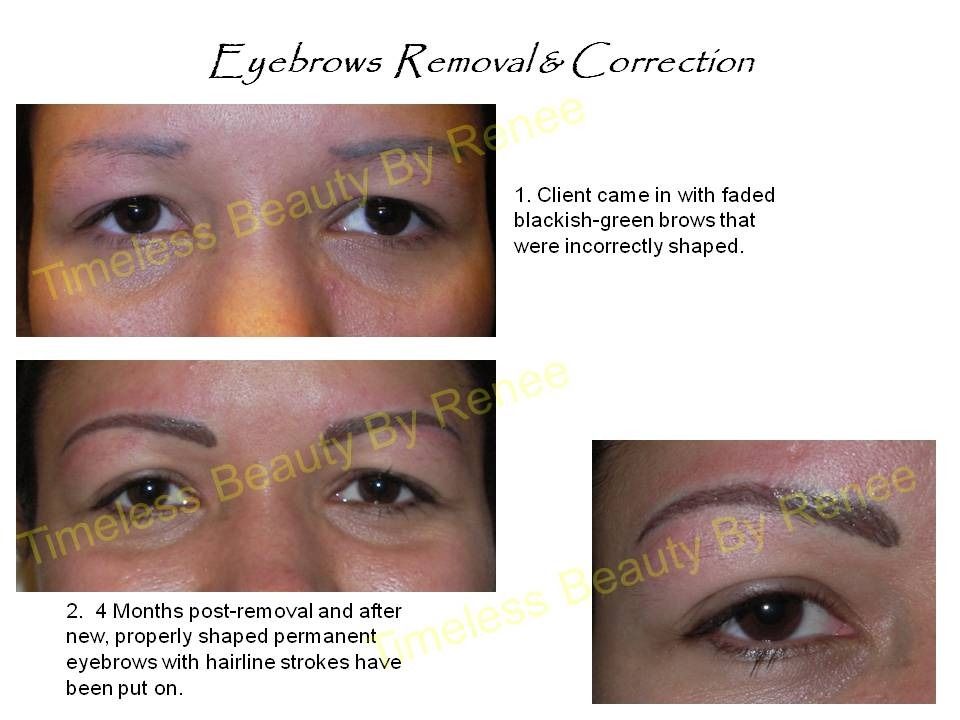 A before and after picture of eyebrows removal and correction