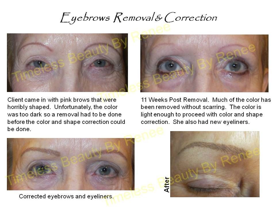 A before and after photo of a woman 's eyebrows removal and correction