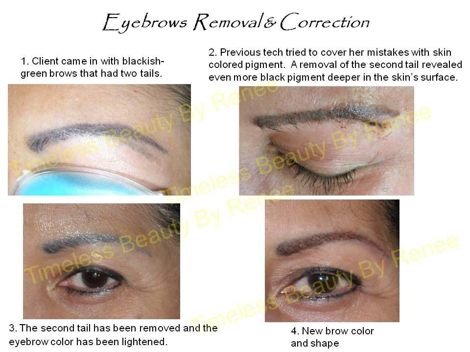 A picture of a woman 's eyebrows removal and correction