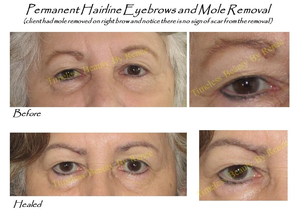 A before and after photo of a woman 's eyebrows and mole removal