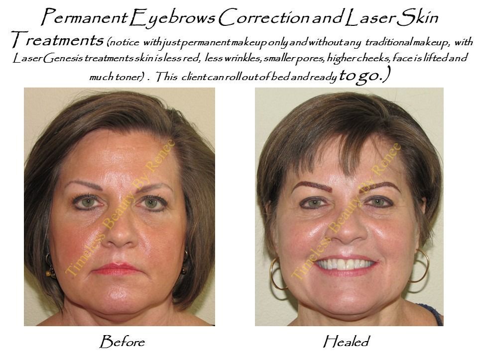 A woman 's face before and after permanent eyebrows correction and laser skin treatments