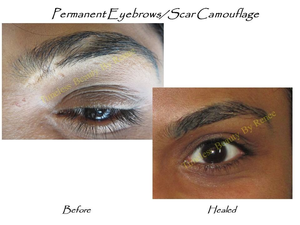 A before and after photo of permanent eyebrows and scar camouflage