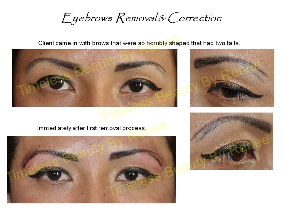 A before and after picture of eyebrows removal and correction