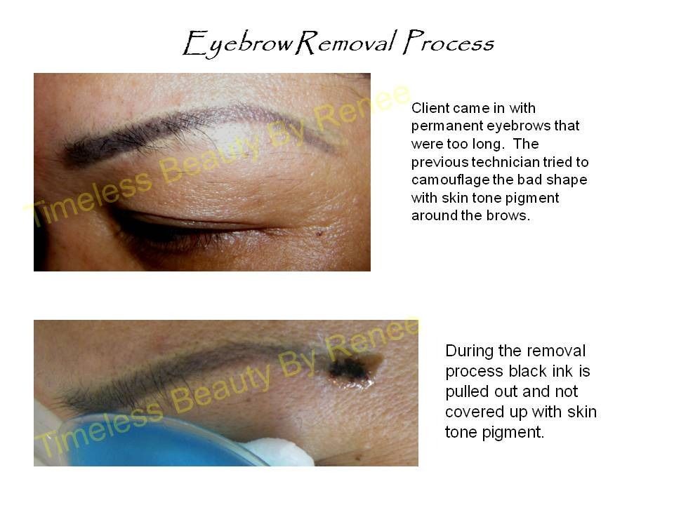 A picture of a woman 's eyebrow removal process