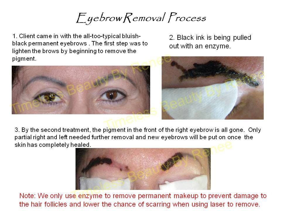 A picture of a woman 's eyebrow removal process