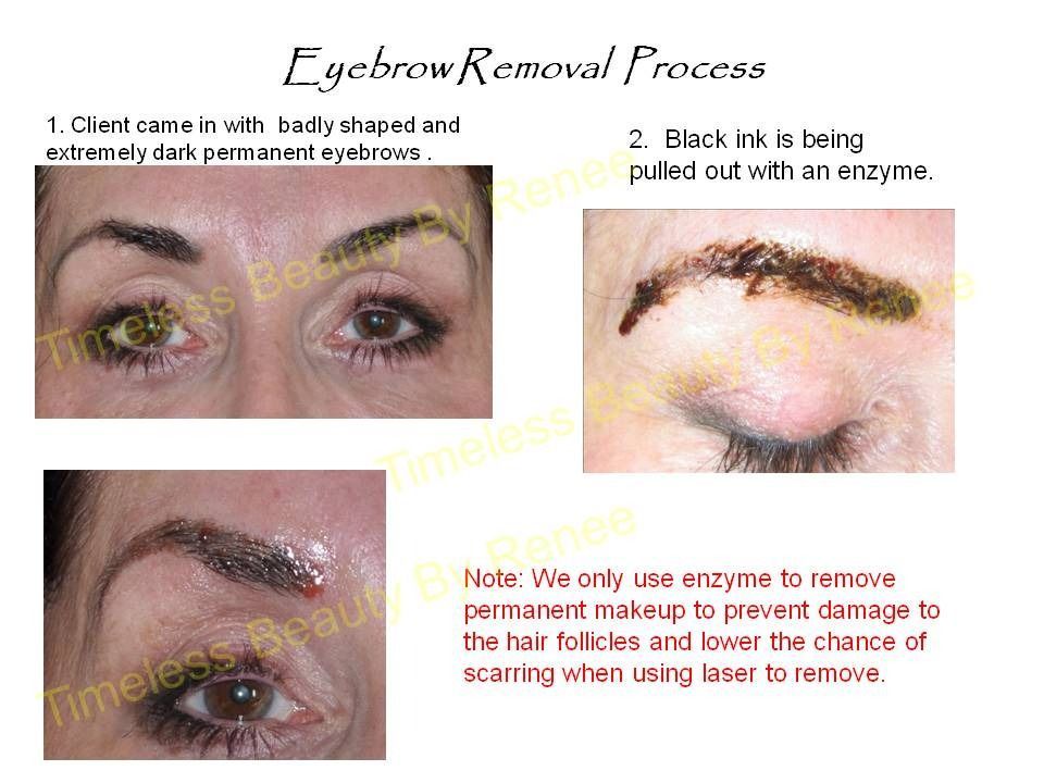 A picture of a woman 's eyebrow removal process