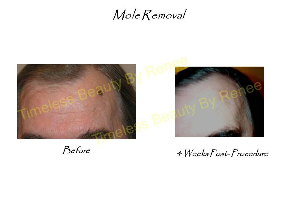 A before and after picture of a mole removal procedure