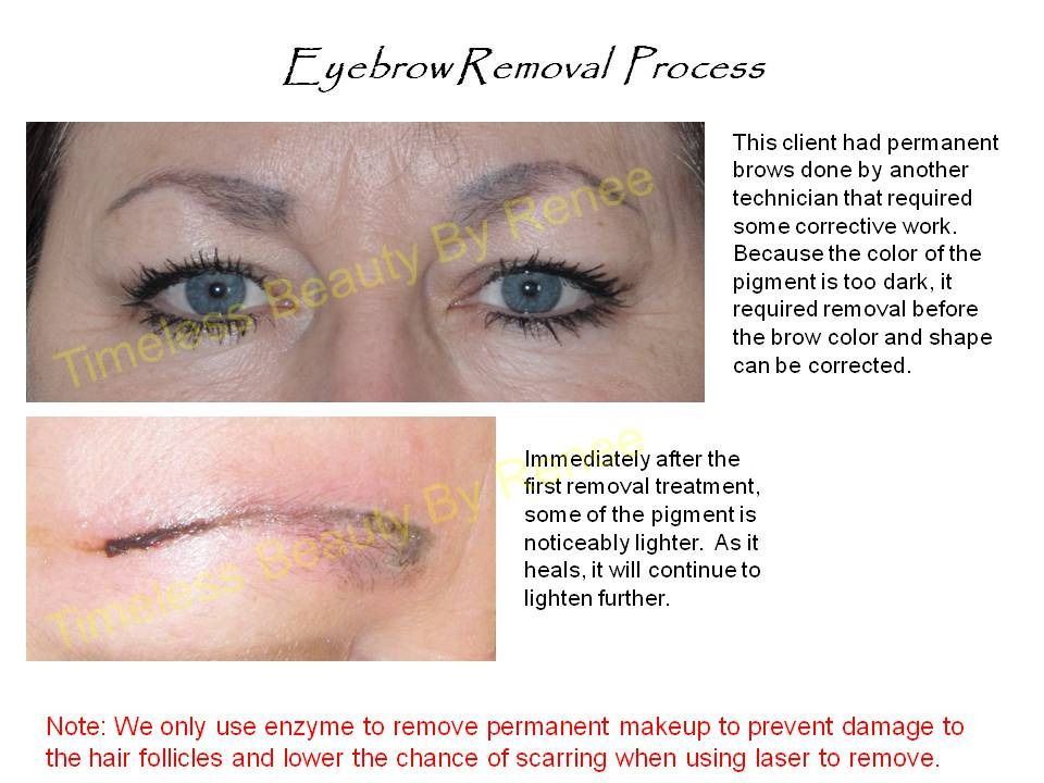 A picture of a woman 's eyebrow removal process