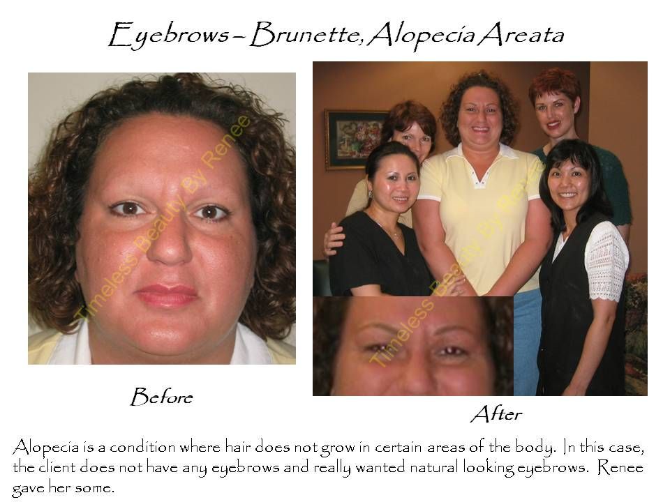A before and after photo of a woman with alopecia areata