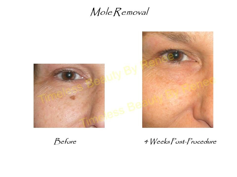 A picture of a woman 's face before and after mole removal