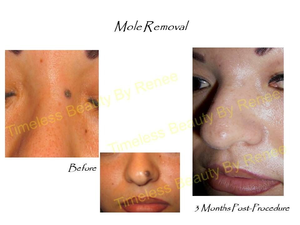 A picture of a woman 's face before and after mole removal