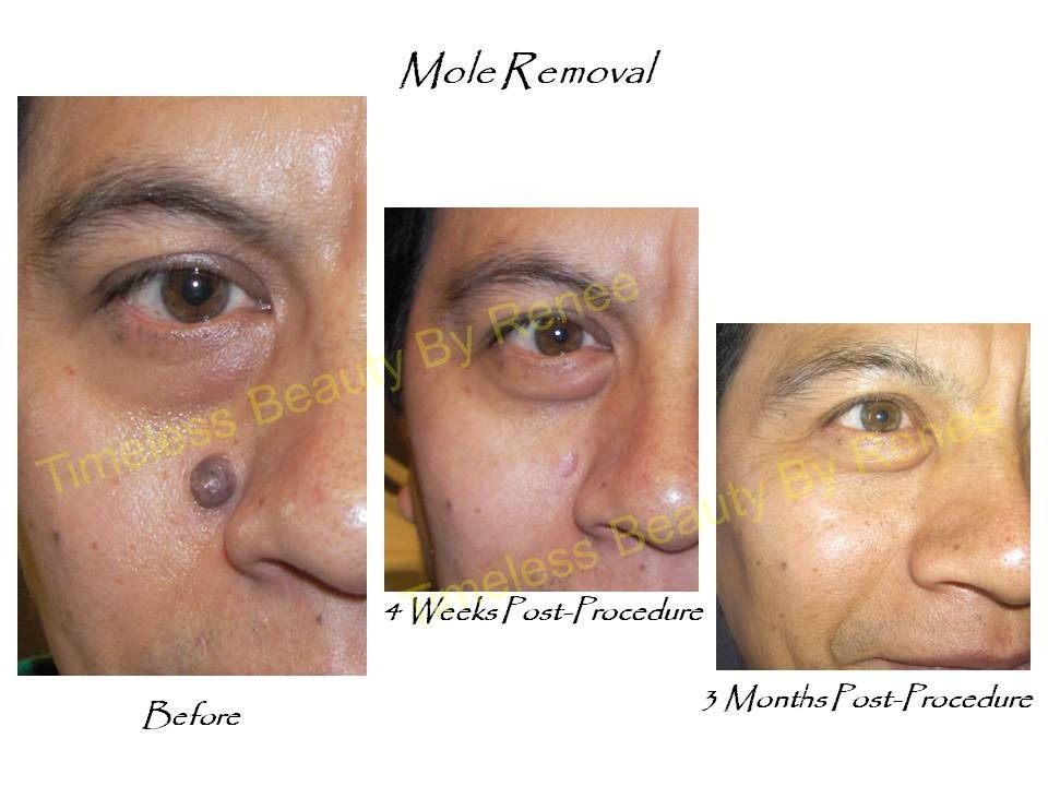 A picture of a man 's face before and after mole removal