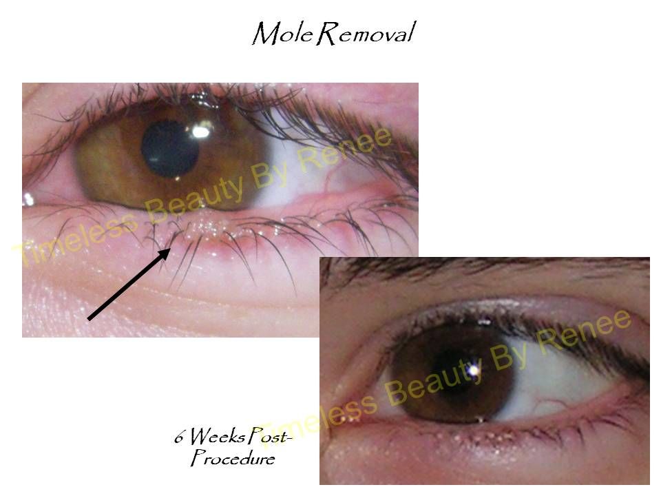 A before and after picture of a mole removal procedure