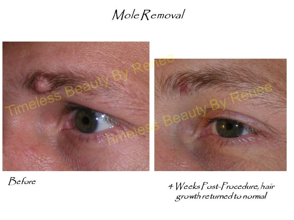 A before and after picture of a mole removal procedure