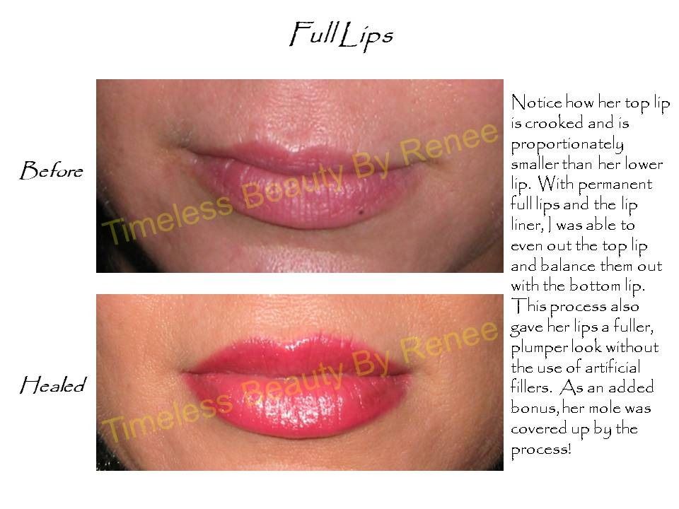 A before and after photo of full lips by renee