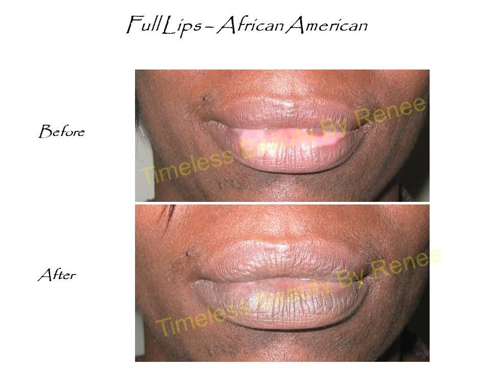 A before and after photo of a woman 's full lips african american