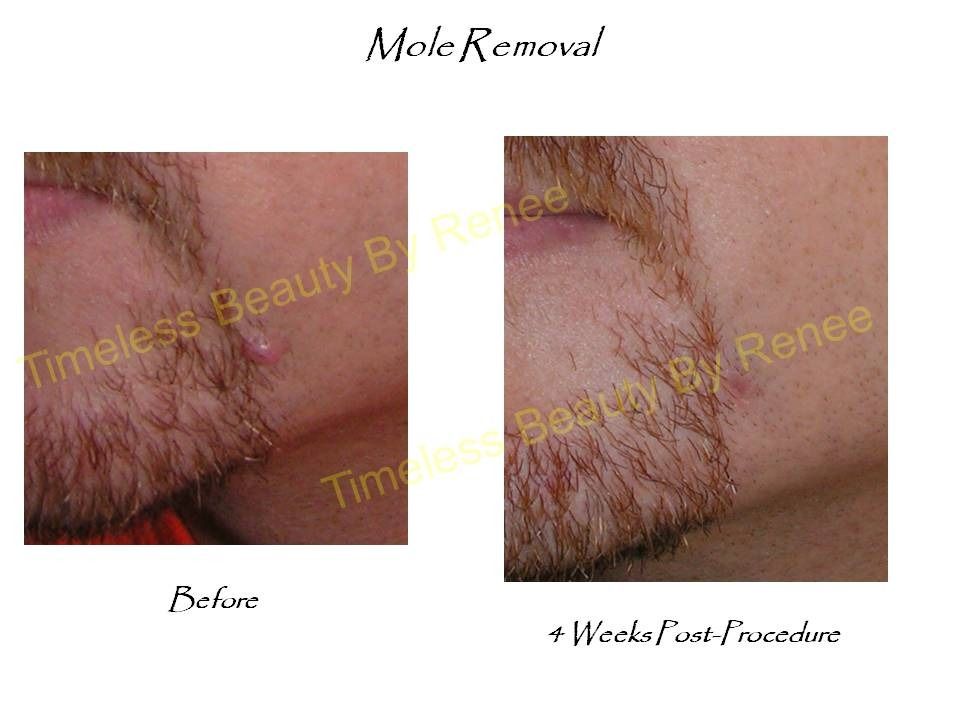 A before and after picture of a mole removal procedure