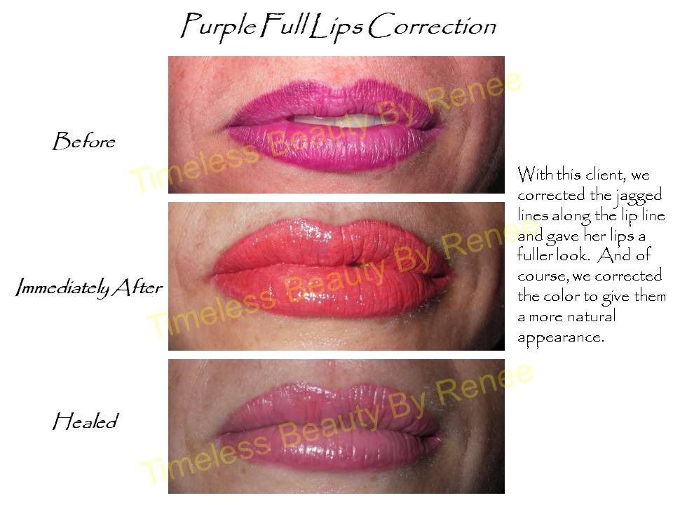 A before and after photo of purple full lips correction
