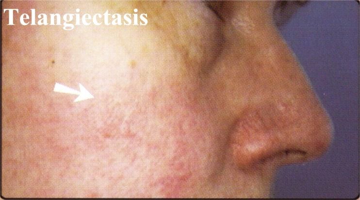 A close up of a person 's face with an arrow pointing to telangiectasis