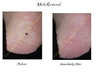 A before and after picture of a mole removal on a person 's skin.