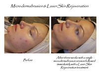 A before and after photo of a woman 's face with acne.