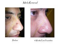 A before and after picture of a man 's nose with mole removal.