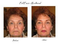 A before and after photo of a woman 's face with red hair.