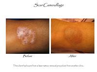 A before and after picture of a scar camouflage tattoo on a person 's arm.