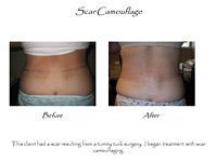 A before and after picture of a woman 's lower back.