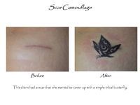 A before and after picture of a scar camouflage tattoo.