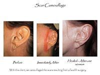A before and after picture of a woman 's ear with scar camouflage.
