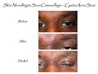 A before and after picture of a person 's face with a scar.