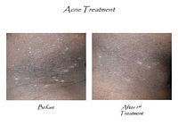 A before and after picture of acne treatment on a person 's neck.