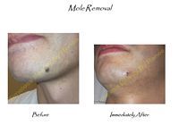 A before and after picture of a mole removal on a man 's chin.