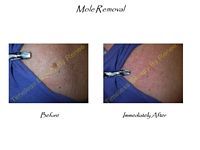 A before and after picture of a mole removal procedure on a woman 's shoulder.