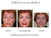 Three pictures of a woman 's face before and after a full face correction.