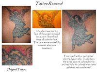 A tattoo of an angel is being removed from a person 's back.