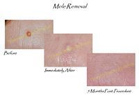 A before and after picture of a mole removal on a person 's skin.