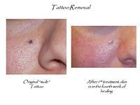 A before and after picture of a tattoo on a person 's face.